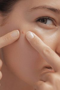 بهترین ترکیبات ضد آکنه در سال 2025